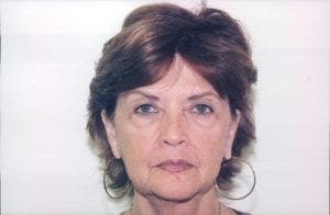 Female Facelift Patient 19 - Before - 1 Thumbnail