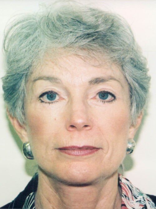 Female Facelift Patient 15 - After - 1