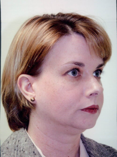 Female Facelift Patient 14 - Before - 1