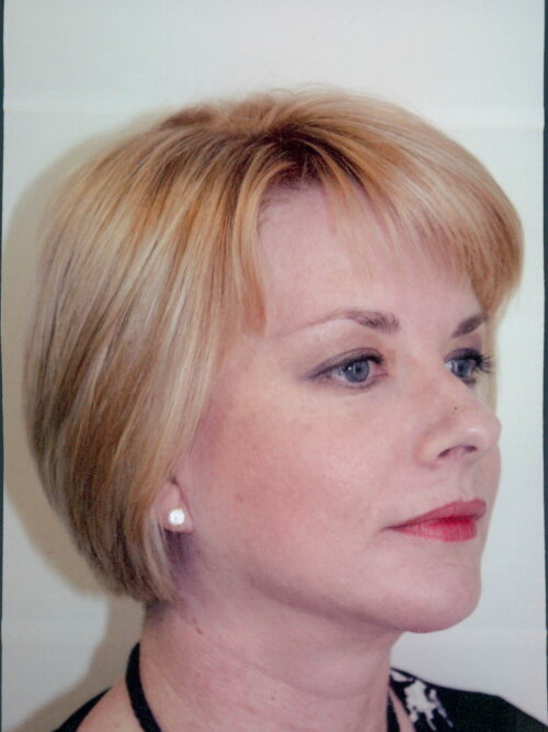 Female Facelift Patient 14 - After - 1