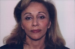 Female Facelift Patient 13 - After - 1 Thumbnail