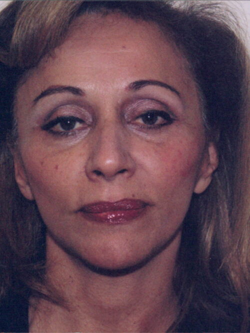 Female Facelift Patient 13 - After - 1