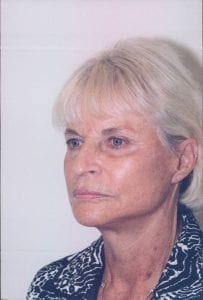 Female Facelift Patient 12 - After - 2 Thumbnail