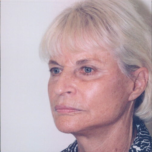 Female Facelift Patient 12 - After - 2