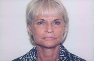 Female Facelift Patient 12 - After - 1 Thumbnail