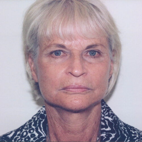 Female Facelift Patient 12 - After - 1