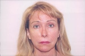 Female Facelift Patient 11 - Before - 1 Thumbnail