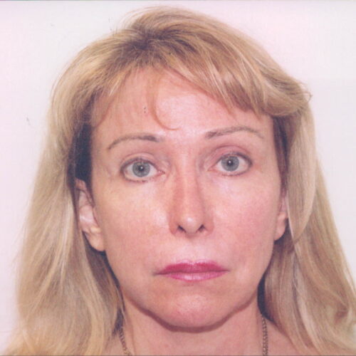 Female Facelift Patient 11 - Before - 1