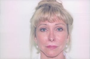 Female Facelift Patient 11 - After - 1 Thumbnail