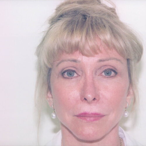 Female Facelift Patient 11 - After - 1