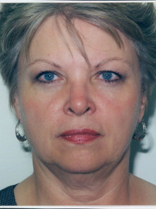 Female Facelift Patient 10 - Before - 1