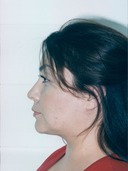 Female Facelift Patient 07 - After - 1