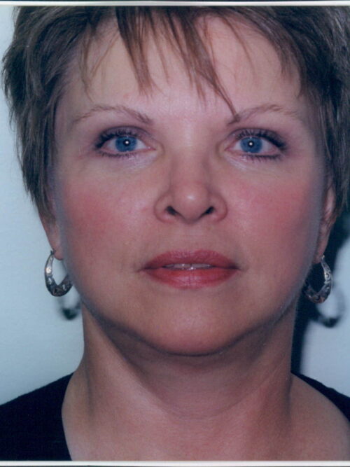 Female Facelift Patient 10 - After - 1