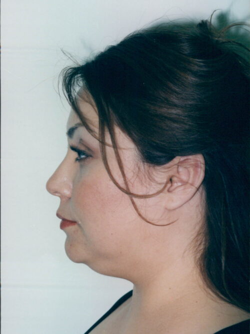 Female Facelift Patient 07 - Before - 1