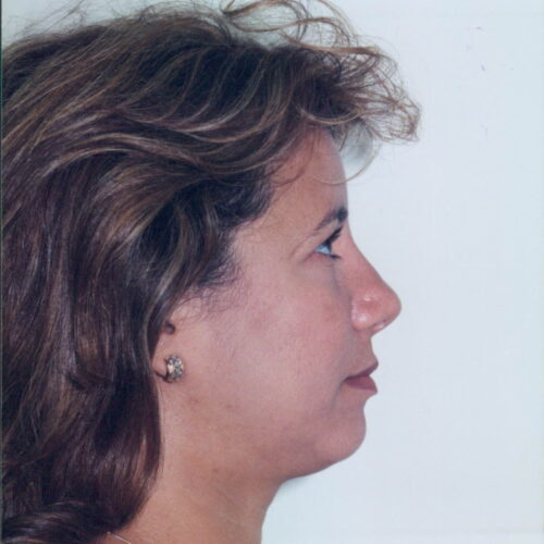 Female Facelift Patient 04 - After - 1