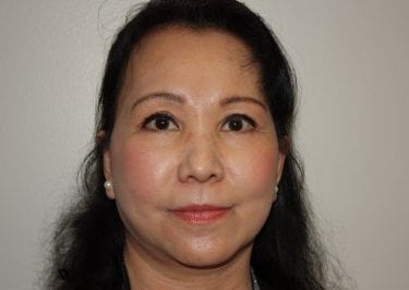 Female Facelift Patient 02 - After - 1