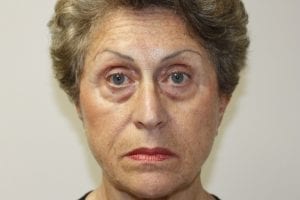 Female Facelift Patient 03 - Before - 1 Thumbnail