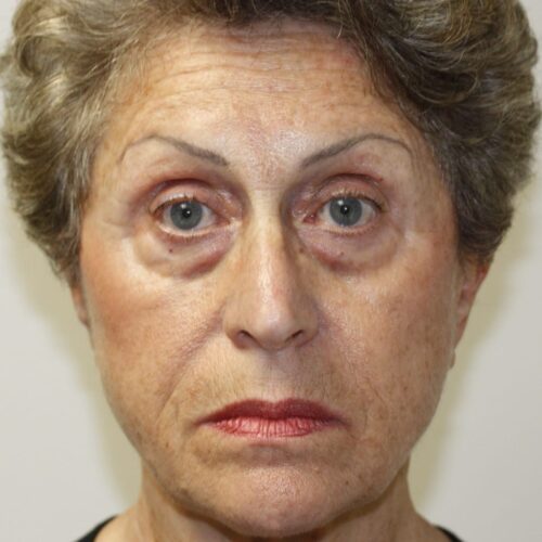 Female Facelift Patient 03 - Before - 1