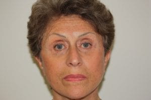 Female Facelift Patient 03 - After - 1 Thumbnail