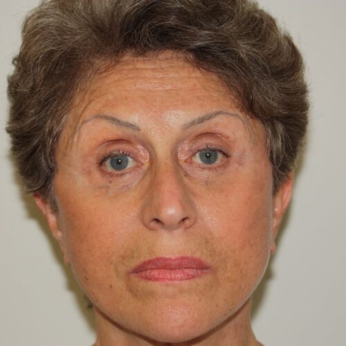 Female Facelift Patient 03 - After - 1