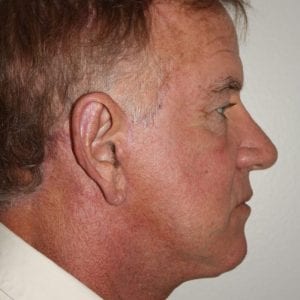 Male Facelift Patient 02 - After - 3 Thumbnail