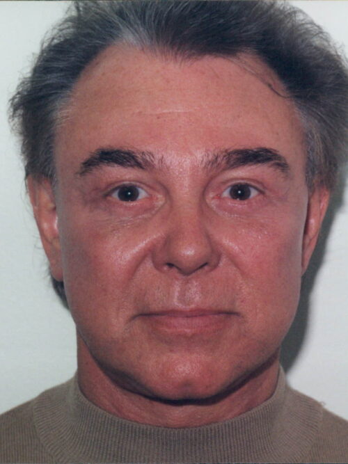 Male Facelift Patient 21 - After - 1