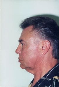 Male Facelift Patient 21 - Before - 2 Thumbnail