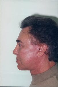 Male Facelift Patient 21 - After - 2 Thumbnail