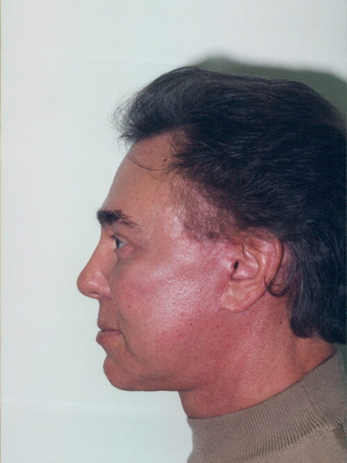 Male Facelift Patient 21 - After - 2