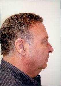 Male Facelift Patient 04 - Before - 2 Thumbnail