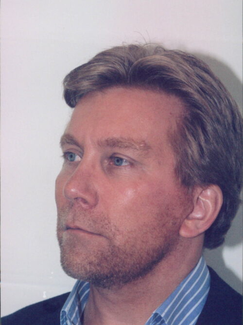 Male Facelift Patient 06 - After - 1