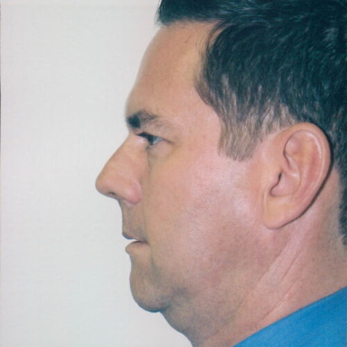 Male Facelift Patient 03 - Before - 1