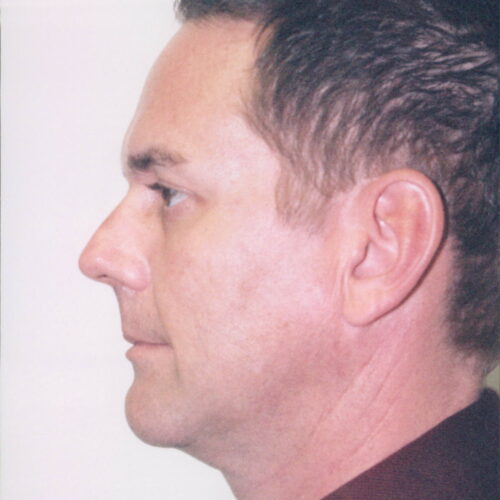 Male Facelift Patient 03 - After - 1