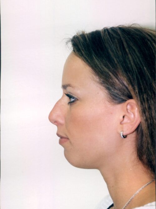 Rhinoplasty Patient 12 - Before - 1