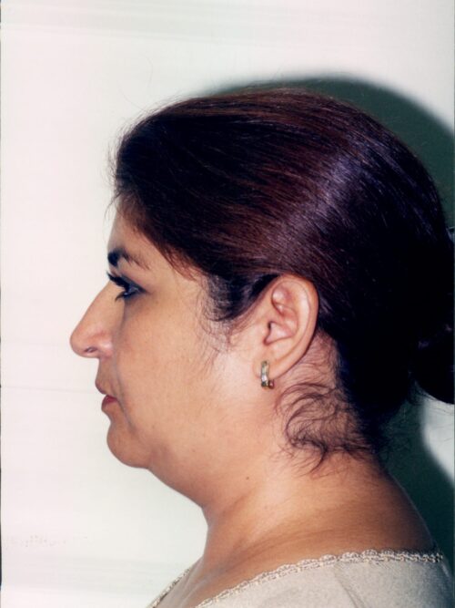 Rhinoplasty Patient 11 - Before - 1