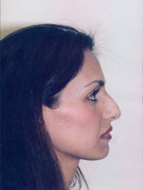 Rhinoplasty Patient 10 - Before - 1