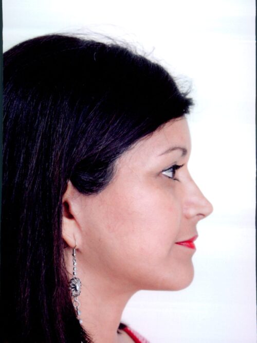 Rhinoplasty Patient 08 - After - 1