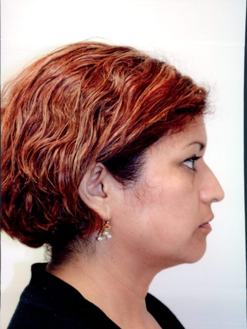 Rhinoplasty Patient 08 - Before - 1