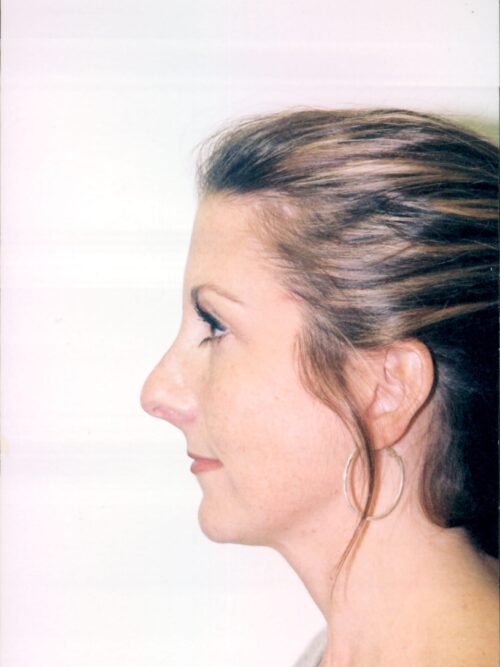 Rhinoplasty Patient 03 - Before - 2