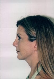 Rhinoplasty Patient 03 - After - 2 Thumbnail