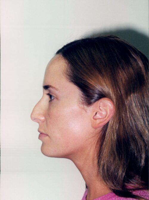 Rhinoplasty Patient 05 - Before - 1