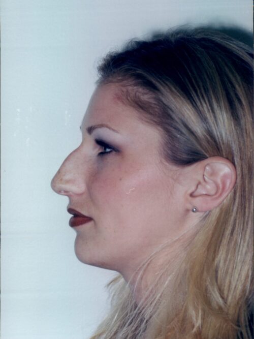 Rhinoplasty Patient 01 - Before - 1