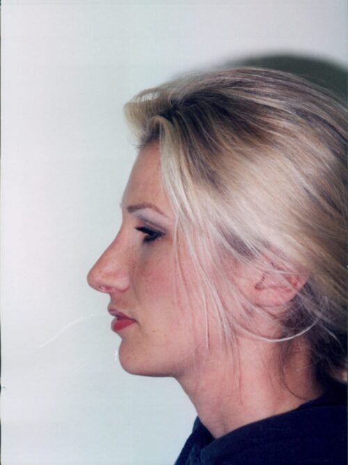 Rhinoplasty Patient 01 - After - 1