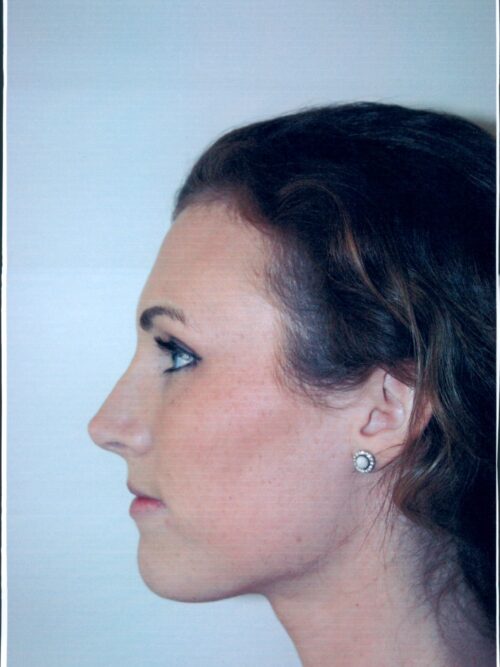 Rhinoplasty Patient 06 - After - 1