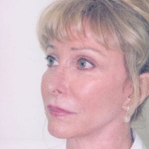 Female Facelift Patient 11 - After - 2 Thumbnail