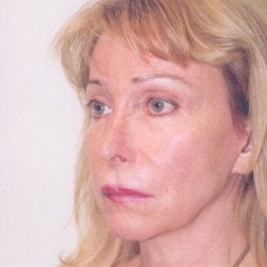 Female Facelift Patient 11 - Before - 2 Thumbnail