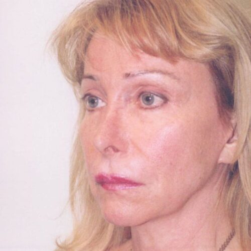 Female Facelift Patient 11 - Before - 2