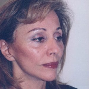 Female Facelift Patient 13 - After - 2 Thumbnail