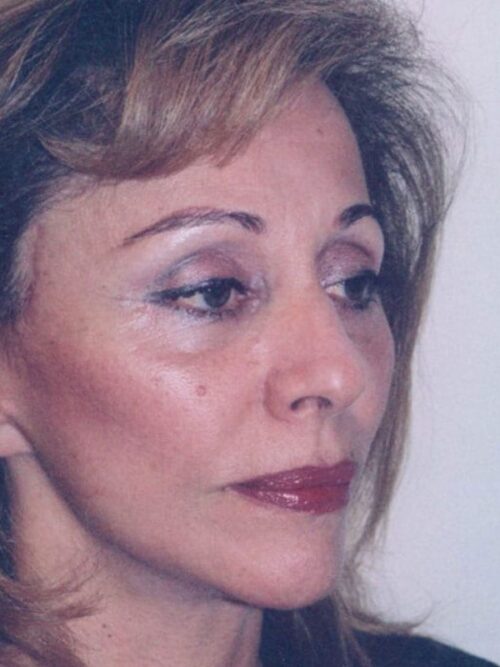 Female Facelift Patient 13 - After - 2