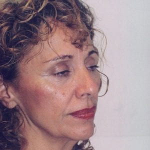 Female Facelift Patient 13 - Before - 2 Thumbnail